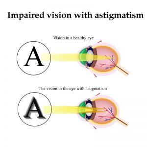 Toric Lens Implants and Astigmatism - Grosinger, Spigelman & Grey