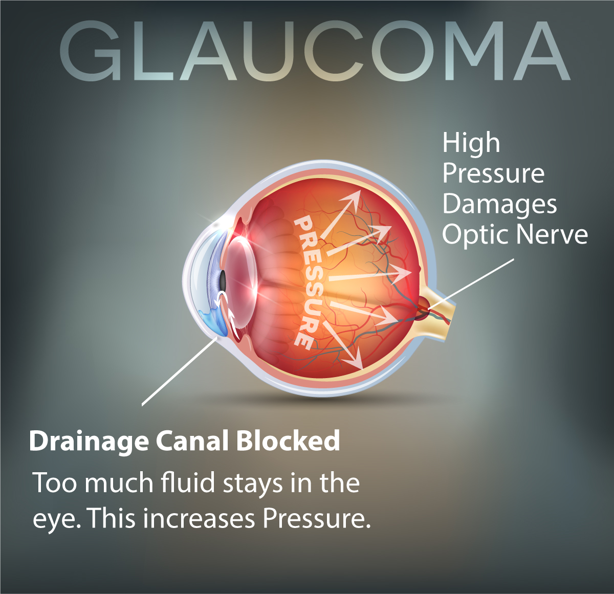 Glaucoma And Treatments In Michigan - Grosinger, Spigelman & Grey